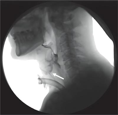 Biomechanical mechanism of reduced aspiration by the Passy-Muir valve in tracheostomized patients following acquired brain injury: Evidences from subglottic pressure